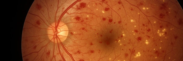 Retinopatia Diabética